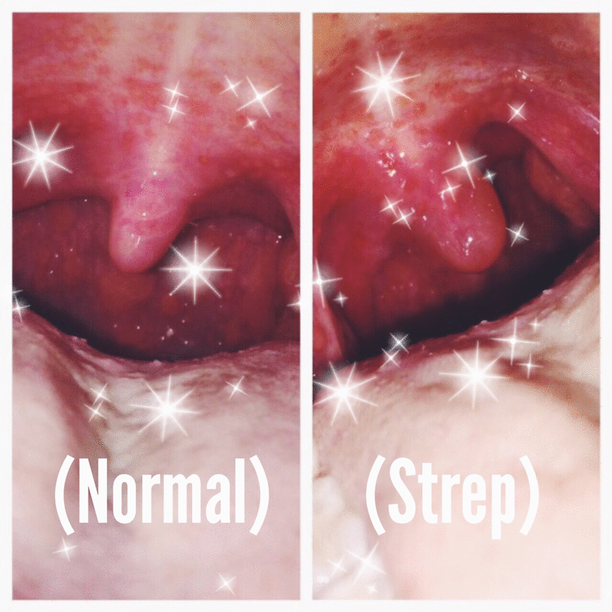 Strep Throat Symtoms 6